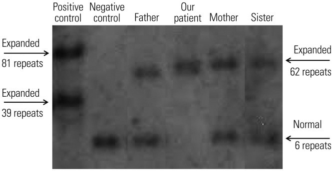 【佳学基因检测】波罗的海肌阵孪性癫痫基因检测 【佳学基因检测】波罗的海肌阵孪性癫痫基因检测